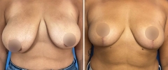 breast-reduction-patient6
