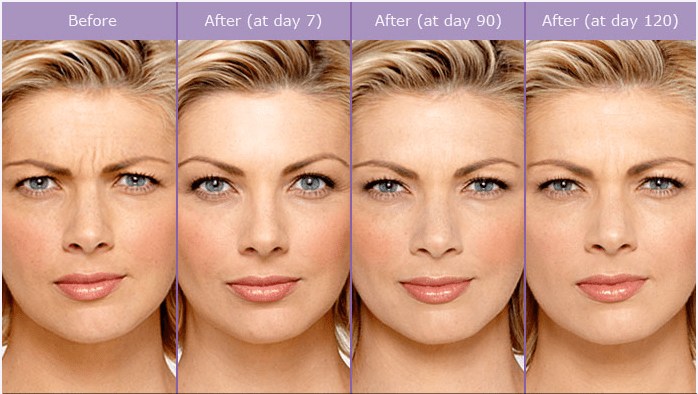 Our Botox Cosmetic / Injectable Fillers - Los Angeles PDFs thumbnail